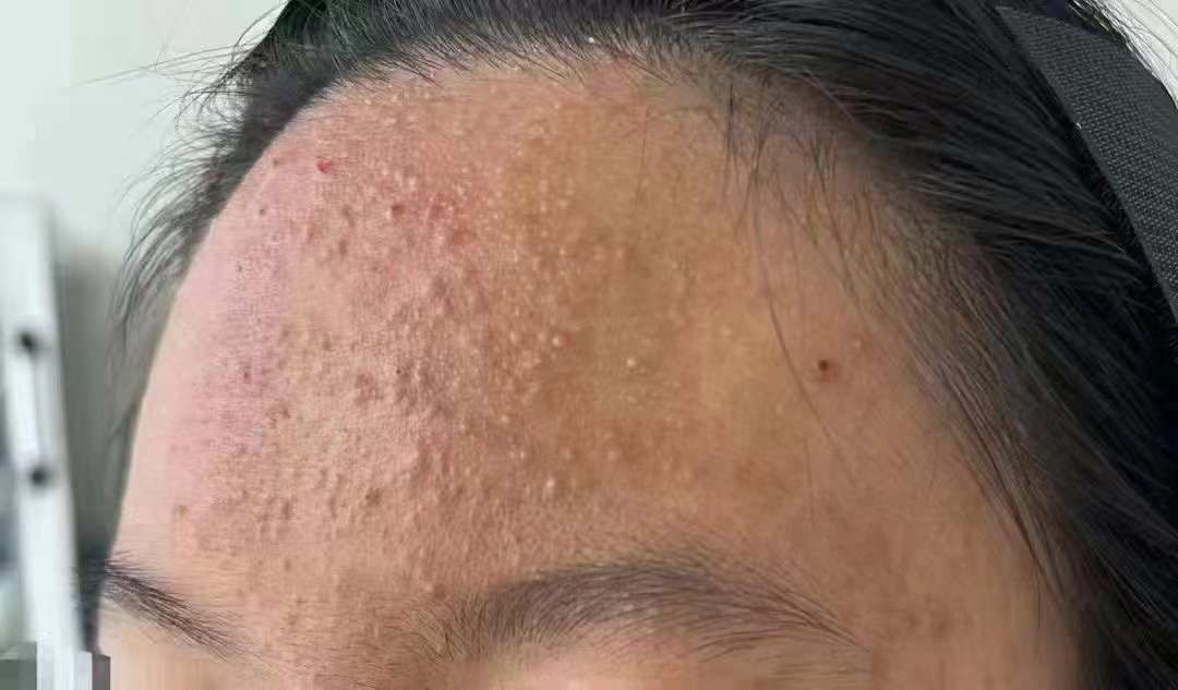 梦见额头长痘怎么解 梦见额头长了一排痘痘